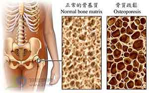 正常骨密度与骨质疏松的骨密度