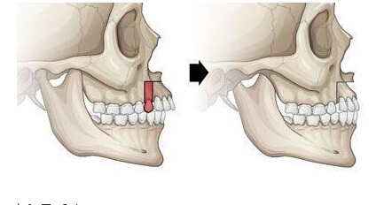 超声波骨密度仪检测骨密度,人到中年牙齿松动真的是人老不中用吗？