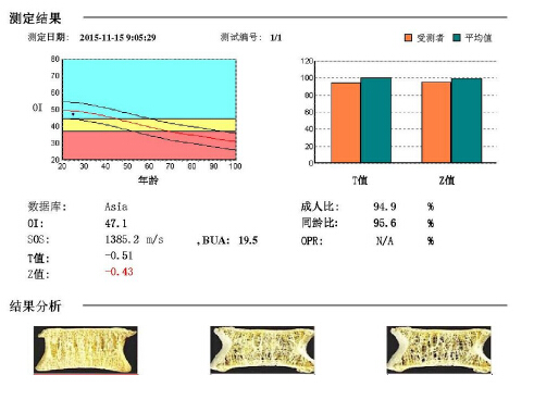 骨密度仪阐述骨质疏松青年不注意老来徒悲伤骨质流失比你想的可怕 骨密度仪阐述骨质疏松青年不注意老来徒悲伤骨质流失比你想的可怕