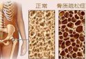 骨密度测试是通过骨密度检测仪器测试你是否患有骨质疏松症