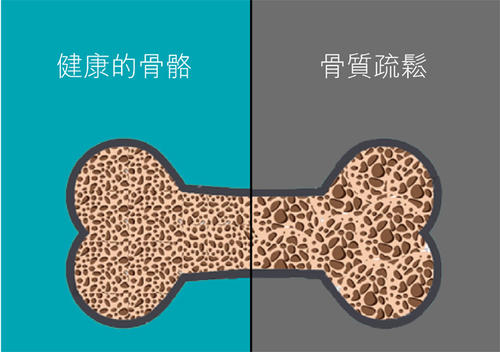 老年人骨质疏松易导致骨折之超声骨密度检查仪的临床价值是什么? 老年人骨质疏松易导致骨折之超声骨密度检查仪的临床价值是什么?