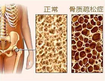 便捷式骨密度检查仪生产厂家 骨密度检测仪厂家
