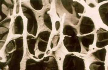 超声骨密度分析仪国产品牌严重的骨质疏松T值是多少？分级是怎样的？